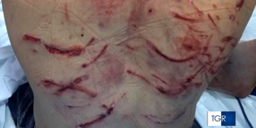 Le ferite provocate dall'attacco dell'orso al carabiniere